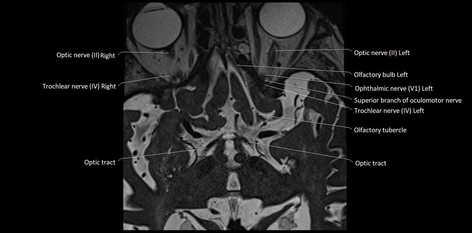 Cranial nerve anatomy axial MRI 3T image 7.webp